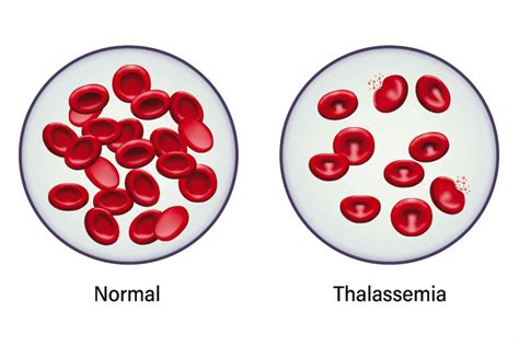 What Beta Thalassemia Does to the Blood .